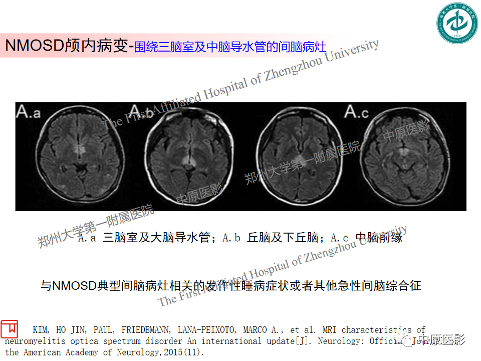 影像PPT - 【PPT】视神经脊髓炎与多发性硬化鉴别诊断-9
