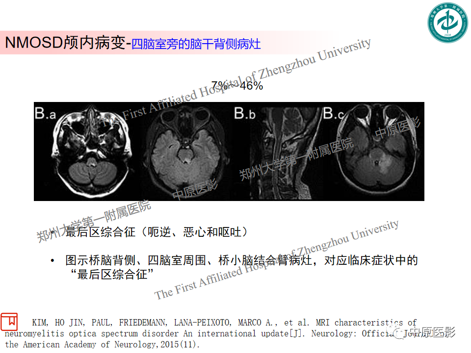 影像PPT - 【PPT】视神经脊髓炎与多发性硬化鉴别诊断-10