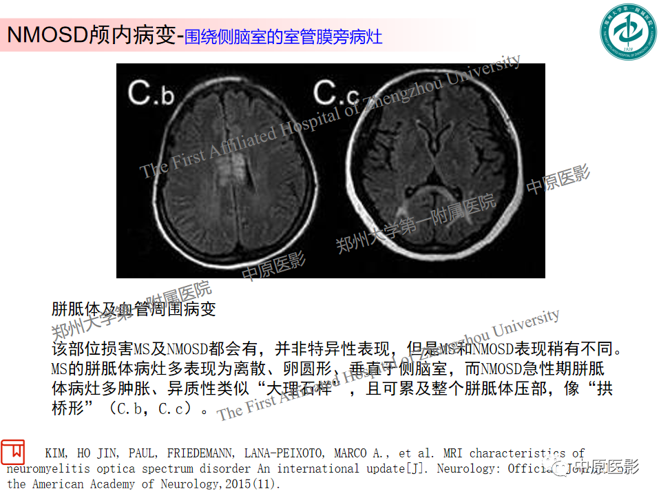 影像PPT - 【PPT】视神经脊髓炎与多发性硬化鉴别诊断-11