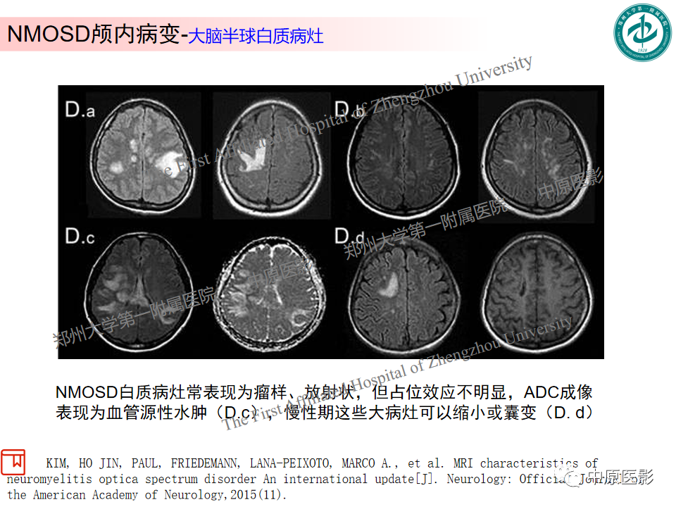 影像PPT - 【PPT】视神经脊髓炎与多发性硬化鉴别诊断-12