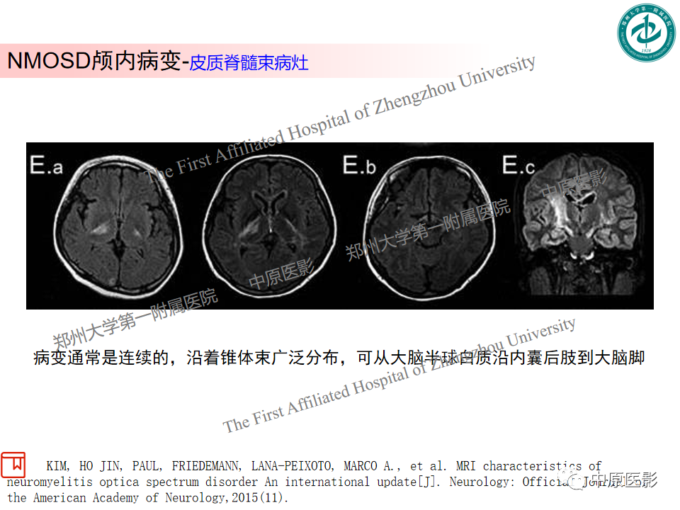 影像PPT - 【PPT】视神经脊髓炎与多发性硬化鉴别诊断-13