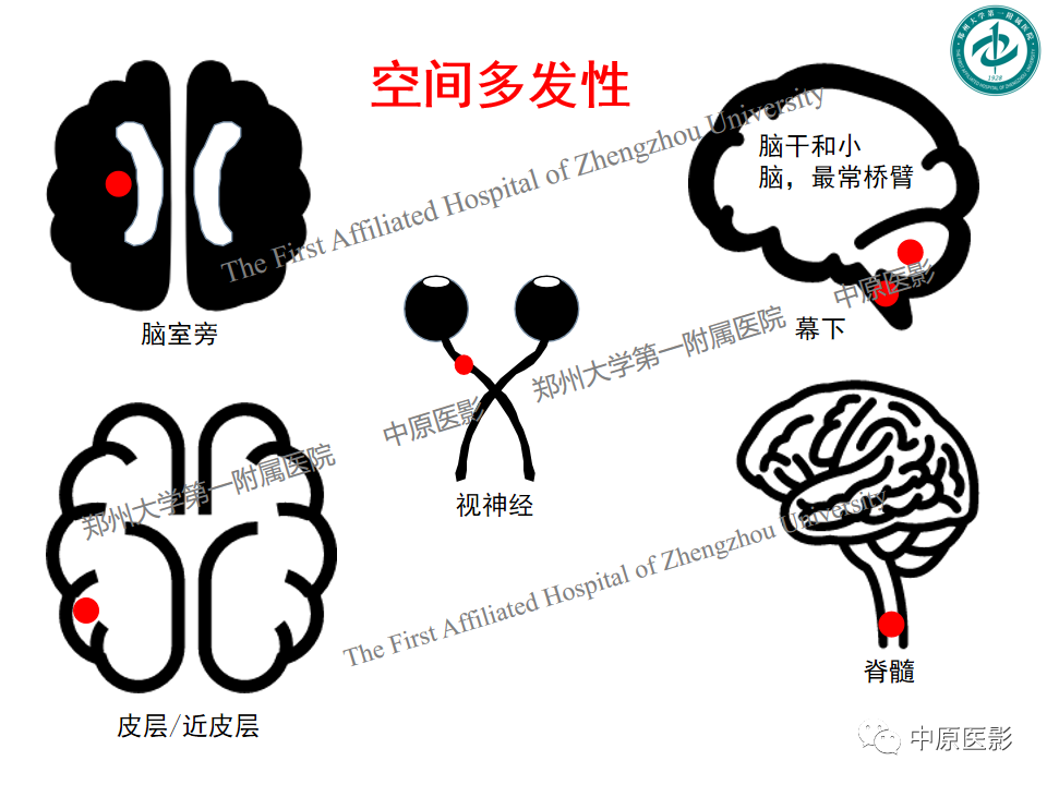 影像PPT - 【PPT】视神经脊髓炎与多发性硬化鉴别诊断-21