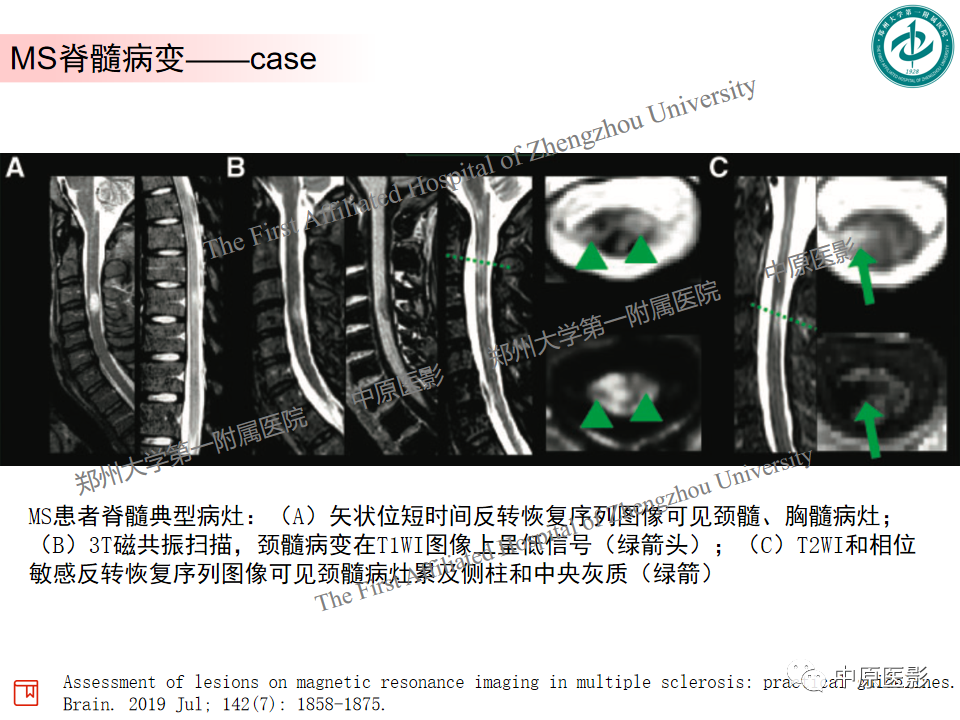 影像PPT - 【PPT】视神经脊髓炎与多发性硬化鉴别诊断-28