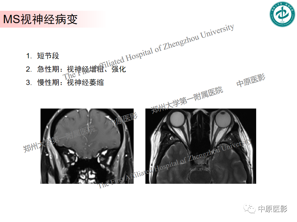 影像PPT - 【PPT】视神经脊髓炎与多发性硬化鉴别诊断-29