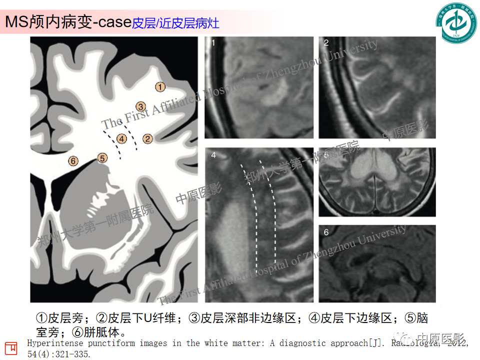 影像PPT - 【PPT】视神经脊髓炎与多发性硬化鉴别诊断-31