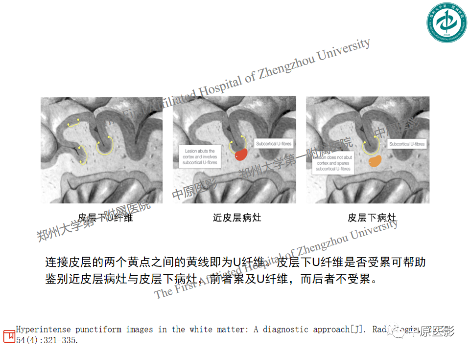 影像PPT - 【PPT】视神经脊髓炎与多发性硬化鉴别诊断-32