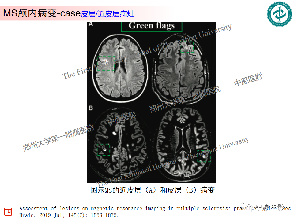 影像PPT - 【PPT】视神经脊髓炎与多发性硬化鉴别诊断-33