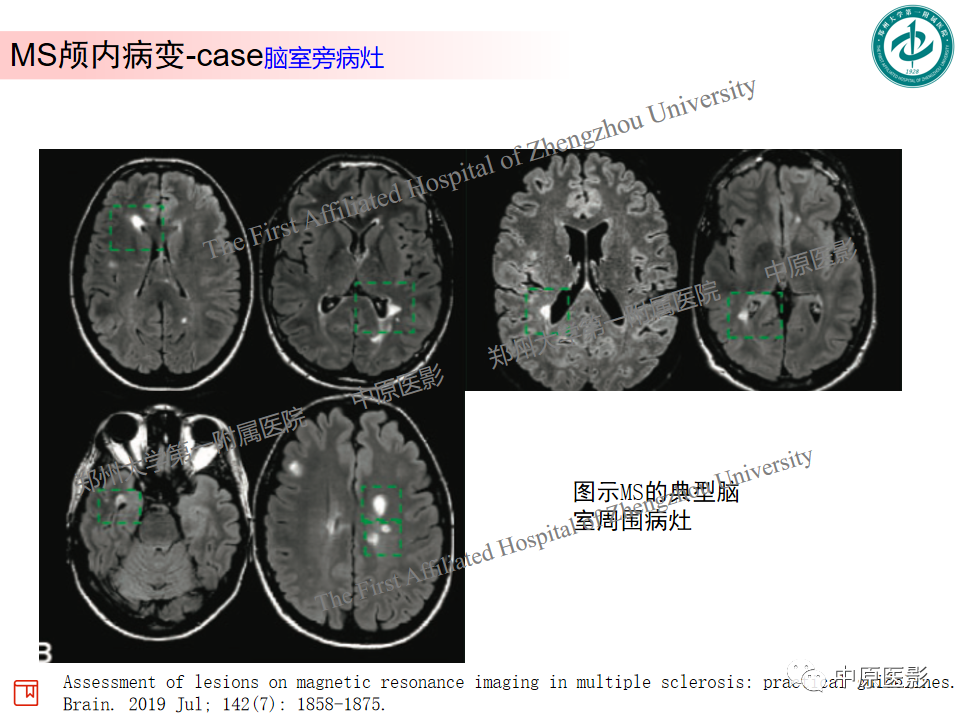 影像PPT - 【PPT】视神经脊髓炎与多发性硬化鉴别诊断-34