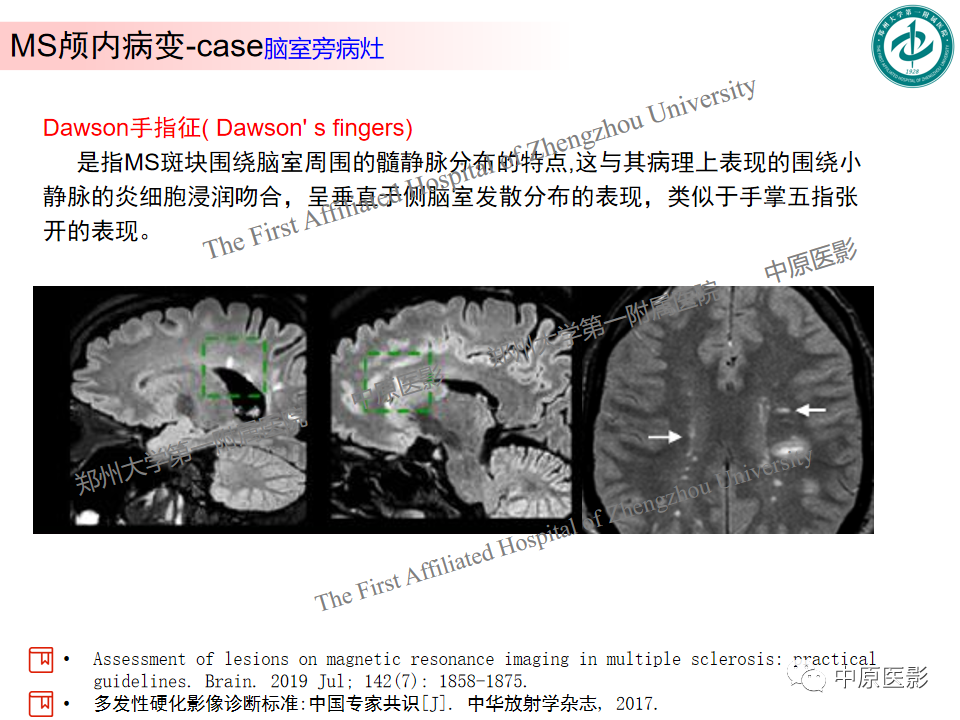 影像PPT - 【PPT】视神经脊髓炎与多发性硬化鉴别诊断-35