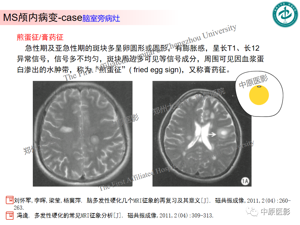 影像PPT - 【PPT】视神经脊髓炎与多发性硬化鉴别诊断-36