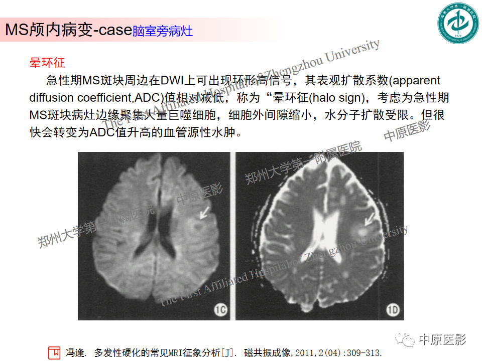 影像PPT - 【PPT】视神经脊髓炎与多发性硬化鉴别诊断-38