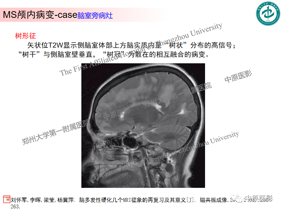 影像PPT - 【PPT】视神经脊髓炎与多发性硬化鉴别诊断-37