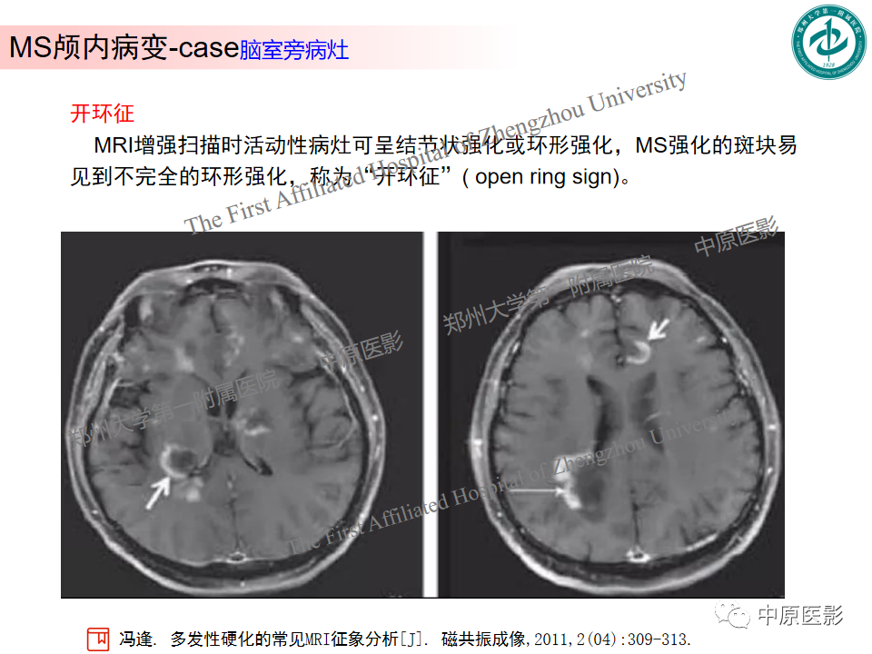 影像PPT - 【PPT】视神经脊髓炎与多发性硬化鉴别诊断-39
