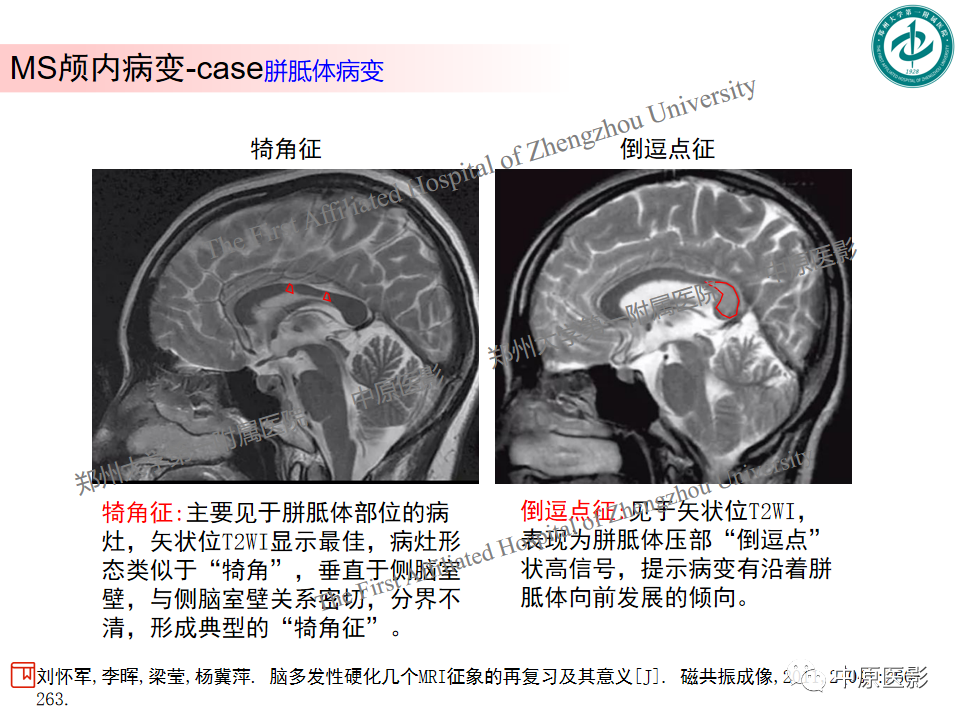 影像PPT - 【PPT】视神经脊髓炎与多发性硬化鉴别诊断-40