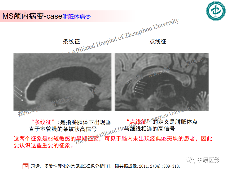 影像PPT - 【PPT】视神经脊髓炎与多发性硬化鉴别诊断-41