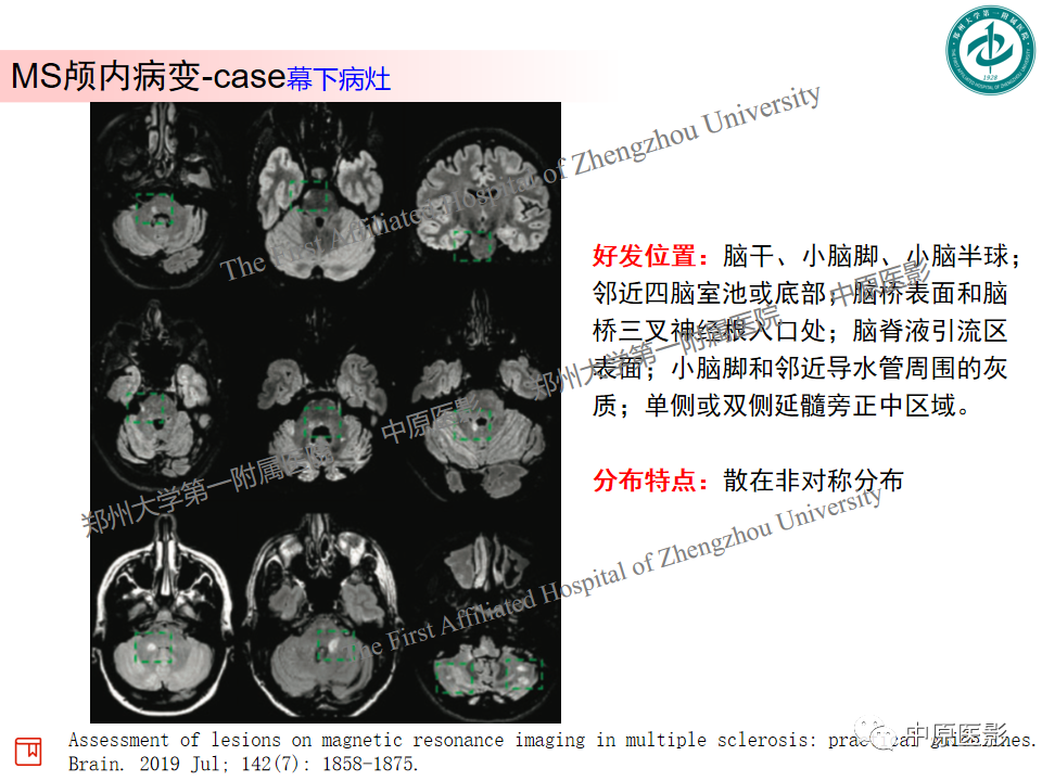 影像PPT - 【PPT】视神经脊髓炎与多发性硬化鉴别诊断-42