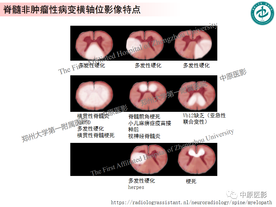 影像PPT - 【PPT】视神经脊髓炎与多发性硬化鉴别诊断-45