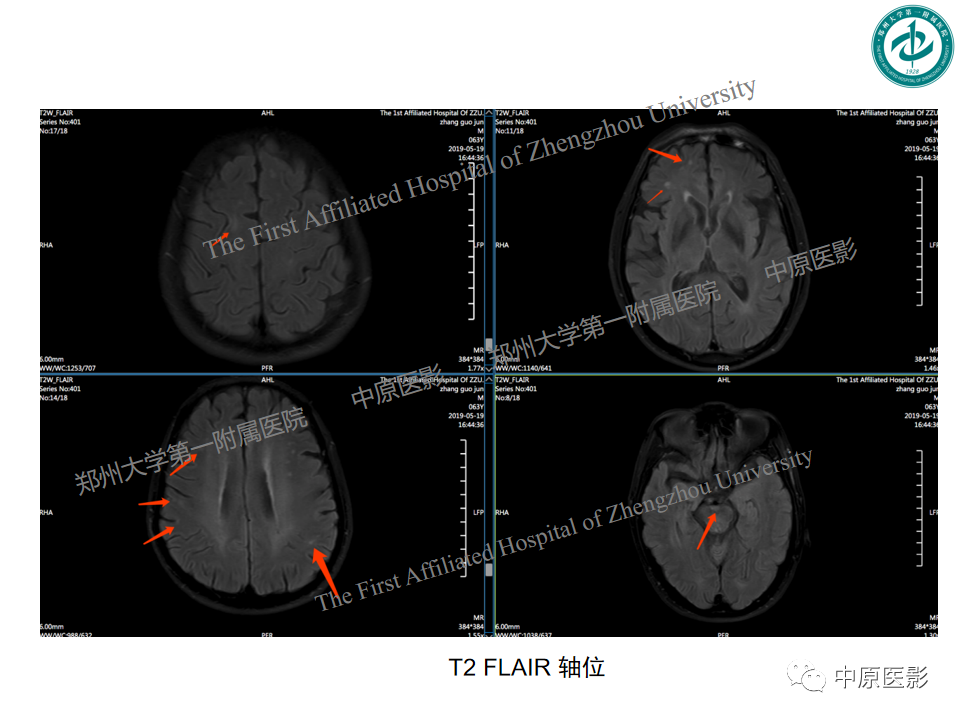 影像PPT - 【PPT】视神经脊髓炎与多发性硬化鉴别诊断-51