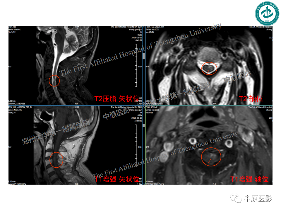 影像PPT - 【PPT】视神经脊髓炎与多发性硬化鉴别诊断-52