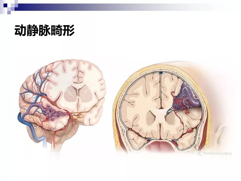影像PPT - 各类脑血管畸形的病理基础、临床、影像学表现-8