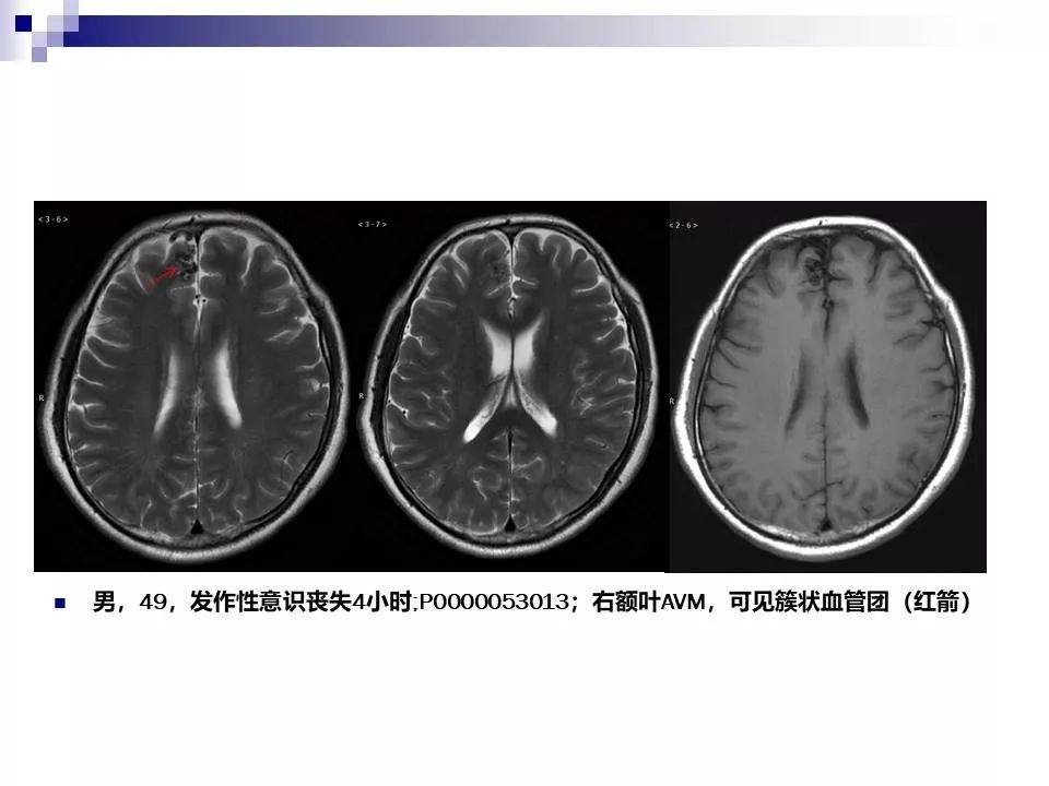 影像PPT - 各类脑血管畸形的病理基础、临床、影像学表现-18
