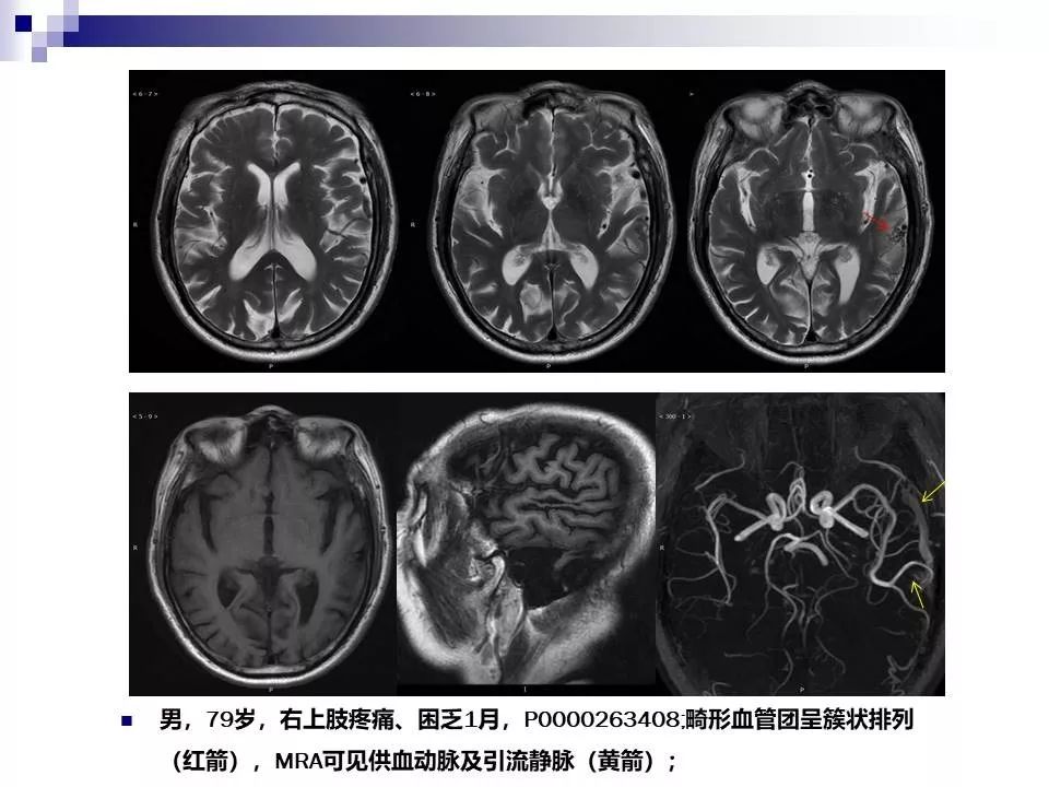 影像PPT - 各类脑血管畸形的病理基础、临床、影像学表现-19