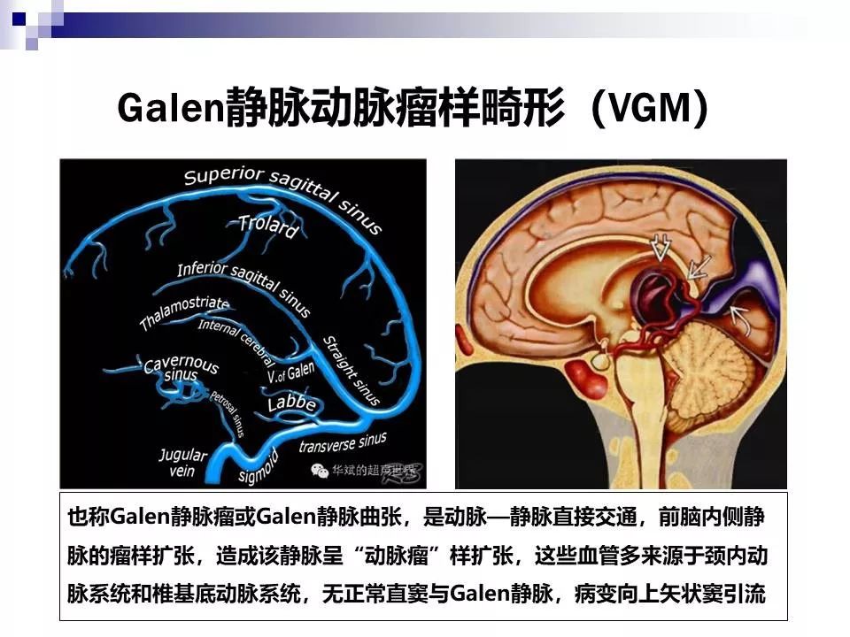 影像PPT - 各类脑血管畸形的病理基础、临床、影像学表现-20