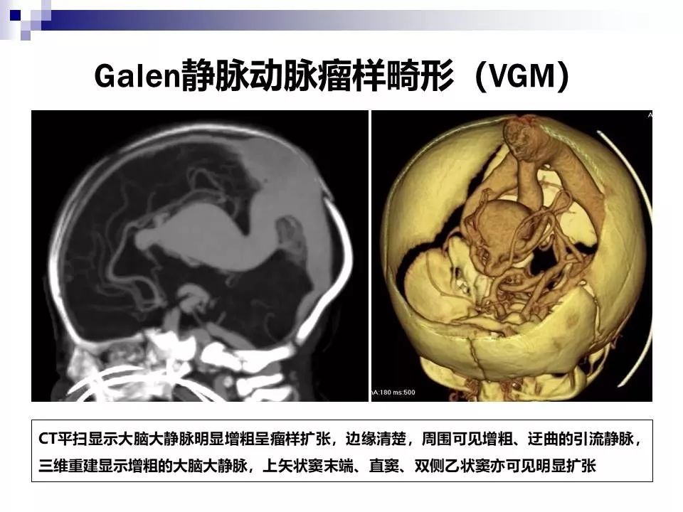 影像PPT - 各类脑血管畸形的病理基础、临床、影像学表现-23