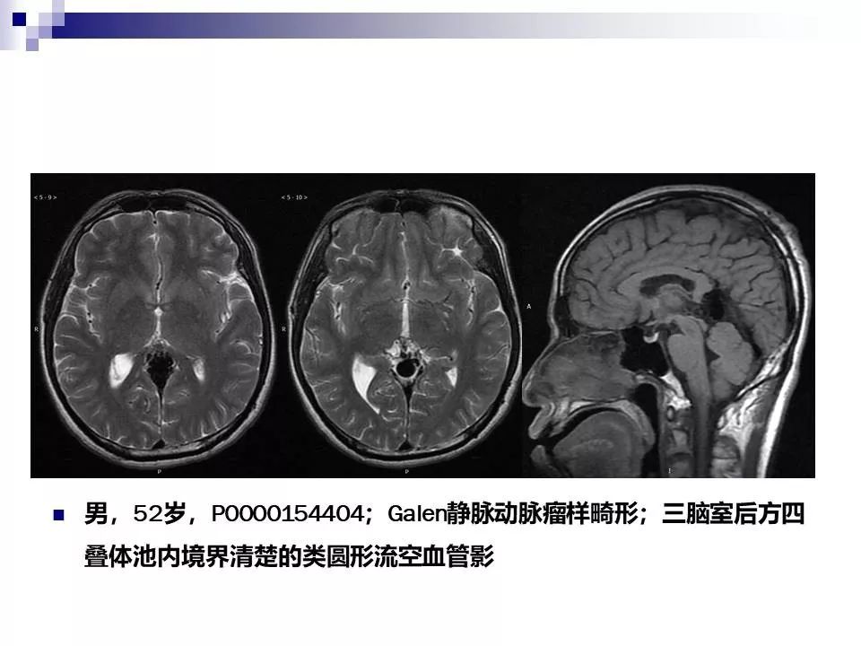 影像PPT - 各类脑血管畸形的病理基础、临床、影像学表现-24