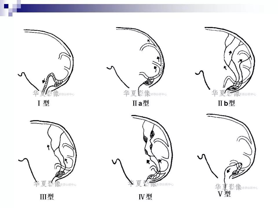 影像PPT - 各类脑血管畸形的病理基础、临床、影像学表现-30