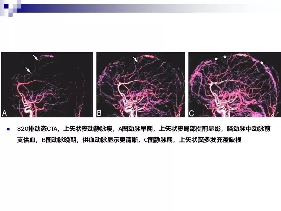 影像PPT - 各类脑血管畸形的病理基础、临床、影像学表现-32