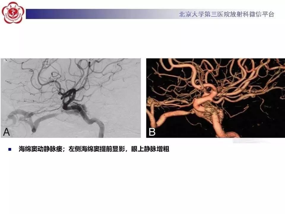 影像PPT - 各类脑血管畸形的病理基础、临床、影像学表现-33