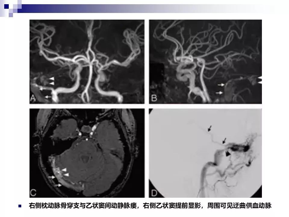影像PPT - 各类脑血管畸形的病理基础、临床、影像学表现-34