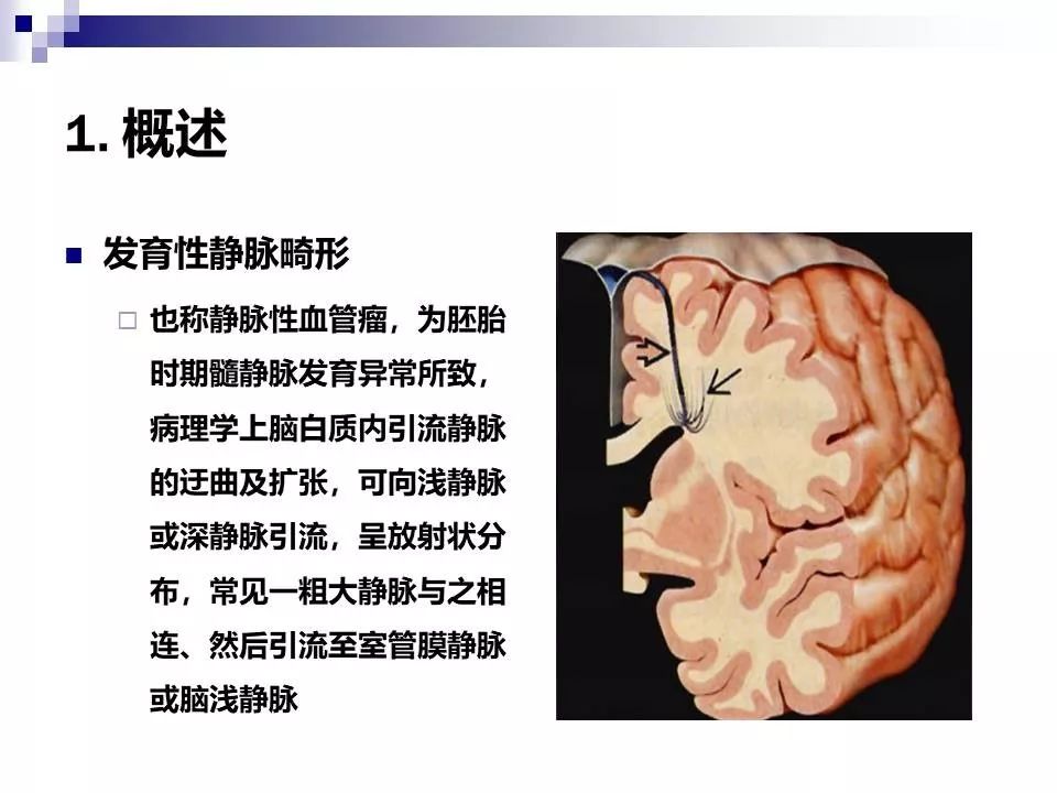 影像PPT - 各类脑血管畸形的病理基础、临床、影像学表现-36
