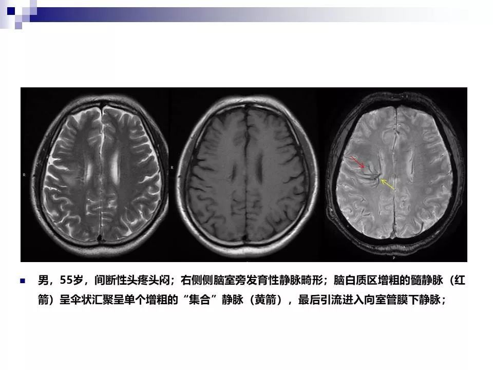 影像PPT - 各类脑血管畸形的病理基础、临床、影像学表现-40