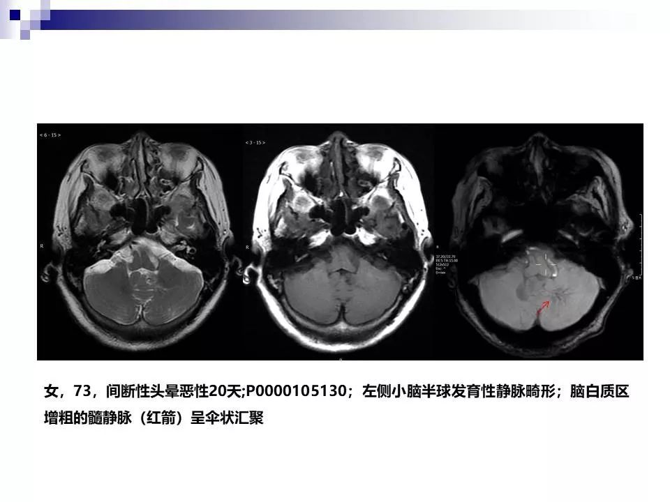 影像PPT - 各类脑血管畸形的病理基础、临床、影像学表现-41
