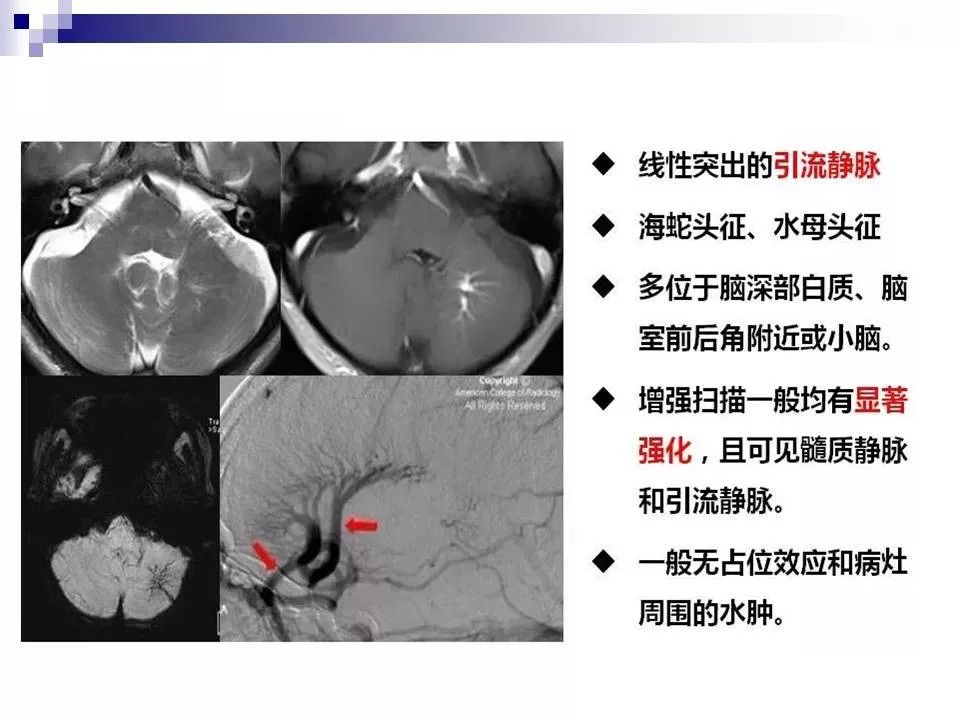 影像PPT - 各类脑血管畸形的病理基础、临床、影像学表现-42