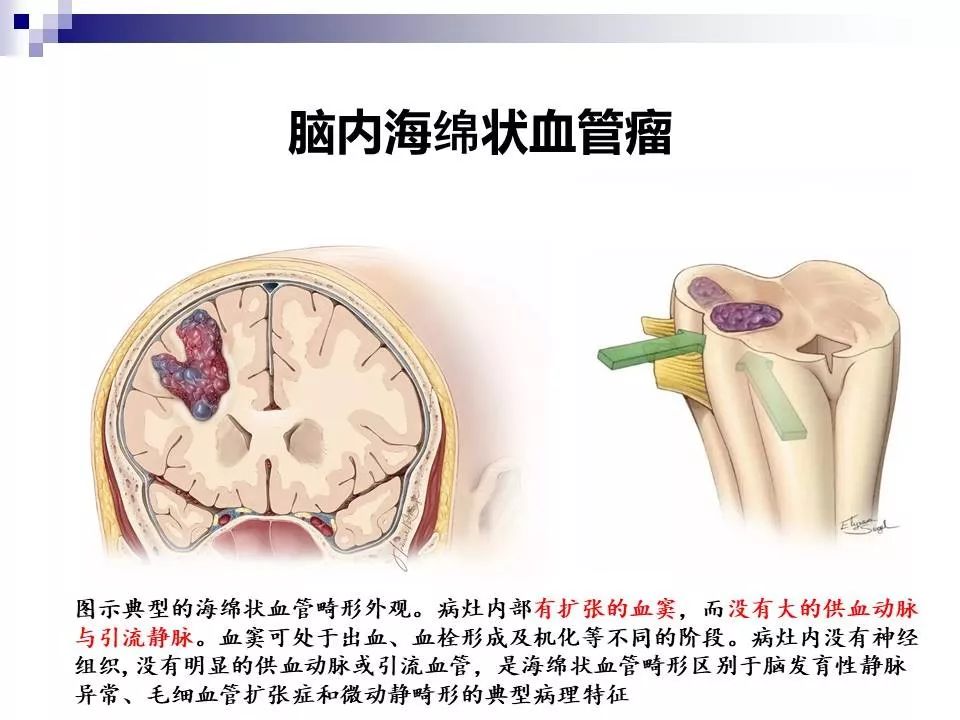 影像PPT - 各类脑血管畸形的病理基础、临床、影像学表现-44