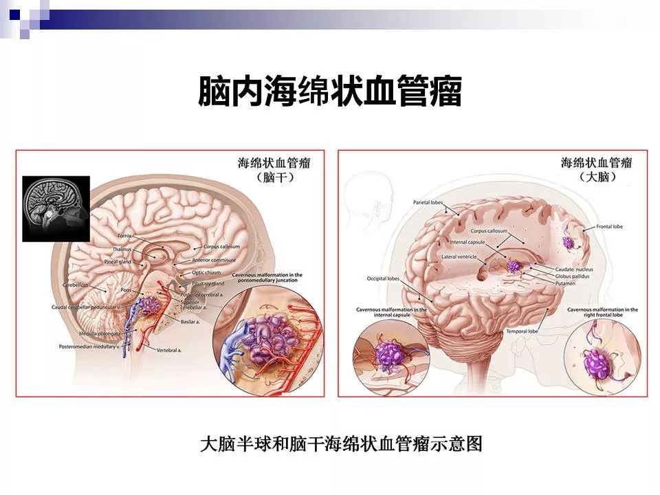 影像PPT - 各类脑血管畸形的病理基础、临床、影像学表现-46