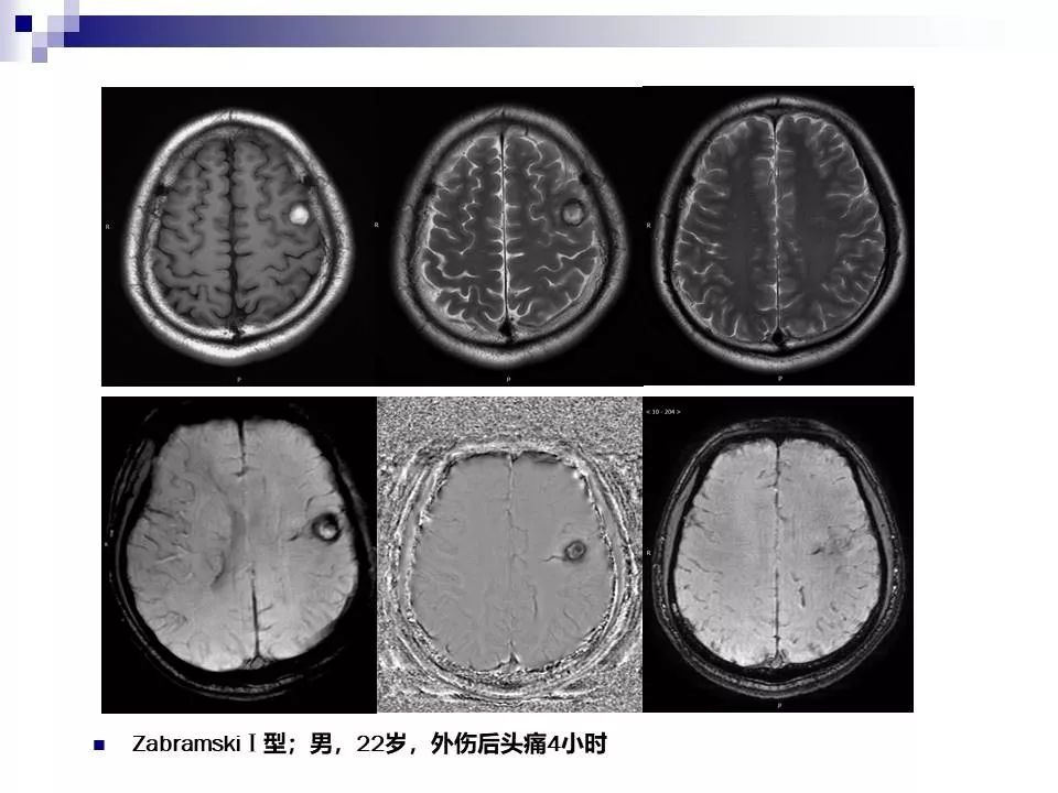 影像PPT - 各类脑血管畸形的病理基础、临床、影像学表现-55