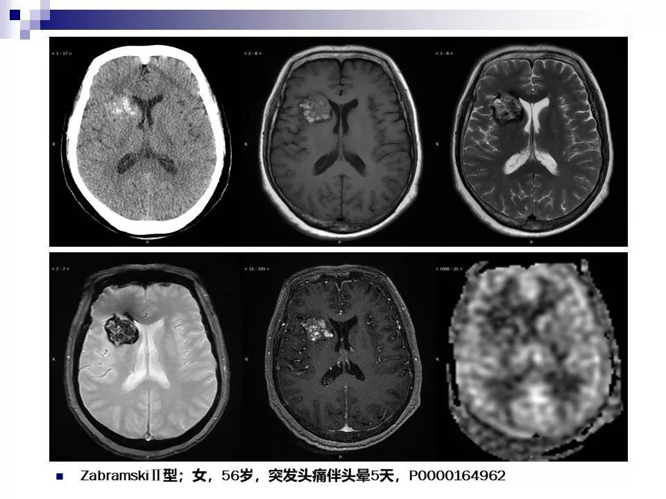 影像PPT - 各类脑血管畸形的病理基础、临床、影像学表现-56