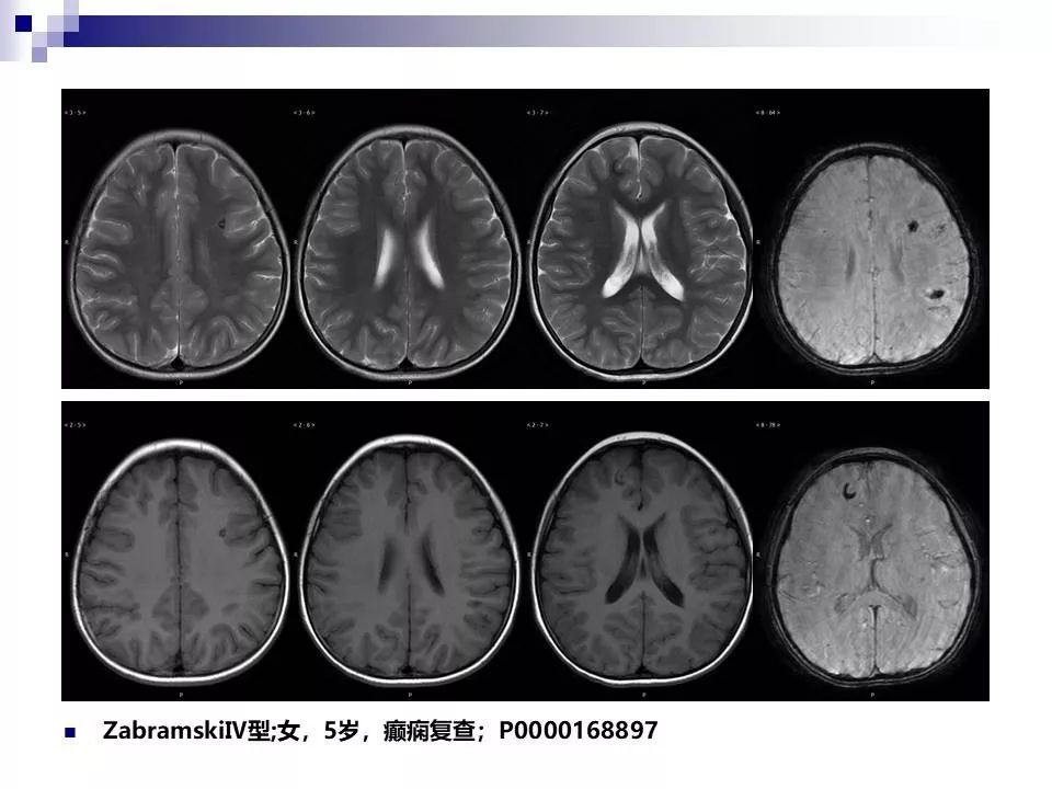 影像PPT - 各类脑血管畸形的病理基础、临床、影像学表现-58