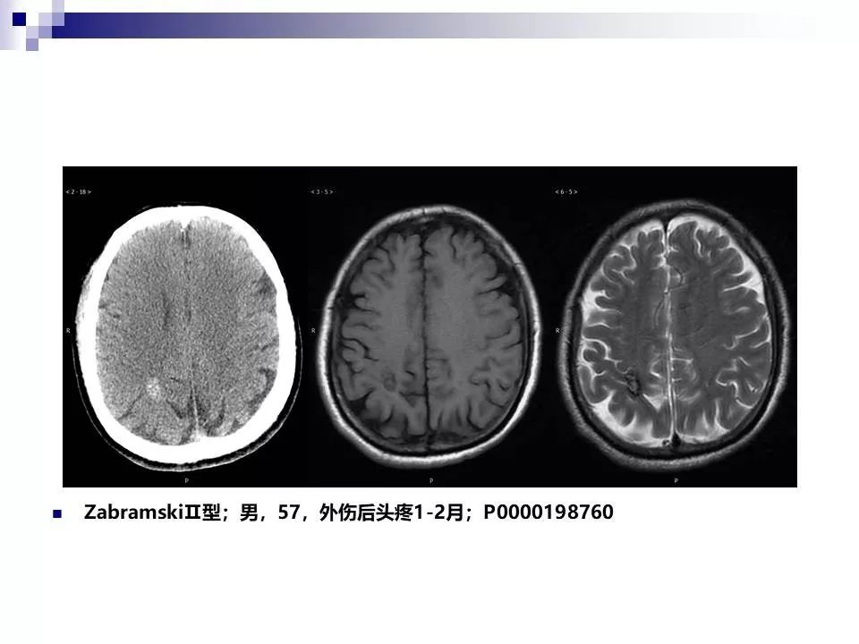 影像PPT - 各类脑血管畸形的病理基础、临床、影像学表现-57