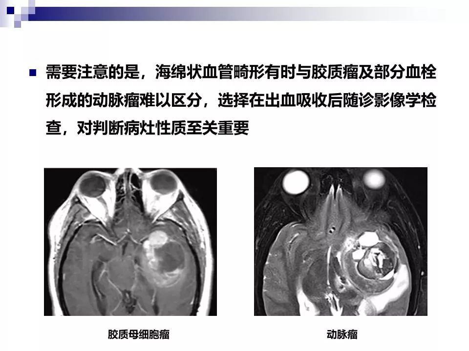 影像PPT - 各类脑血管畸形的病理基础、临床、影像学表现-59