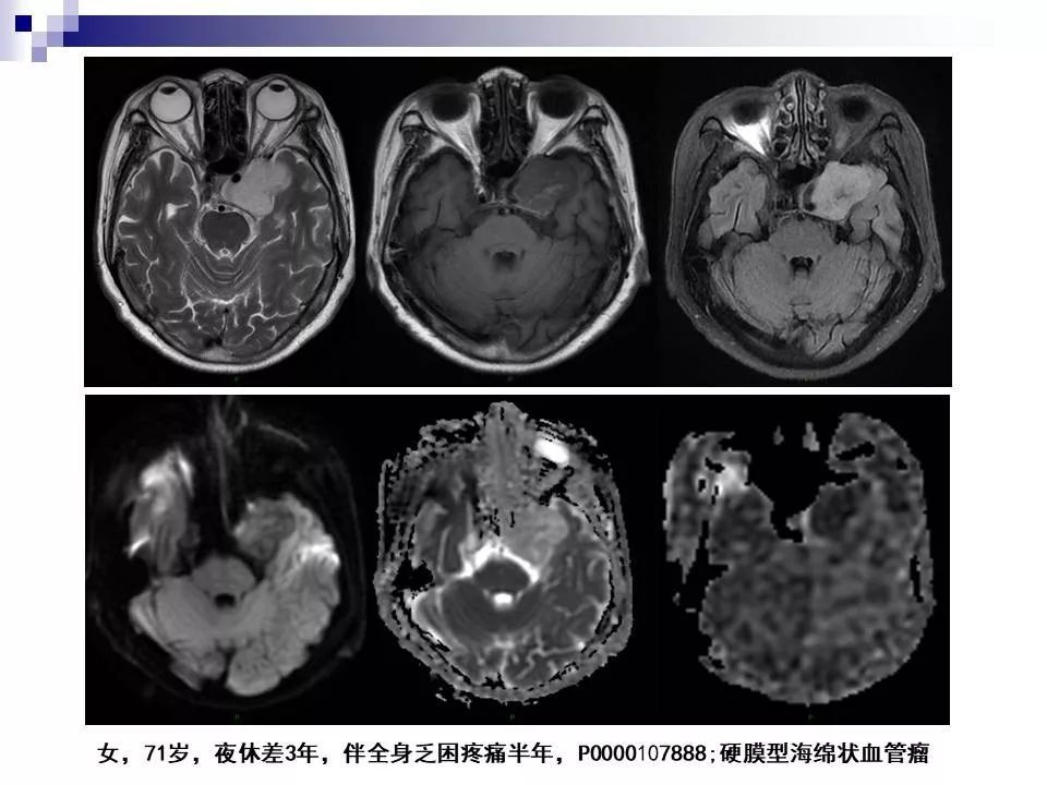 影像PPT - 各类脑血管畸形的病理基础、临床、影像学表现-60