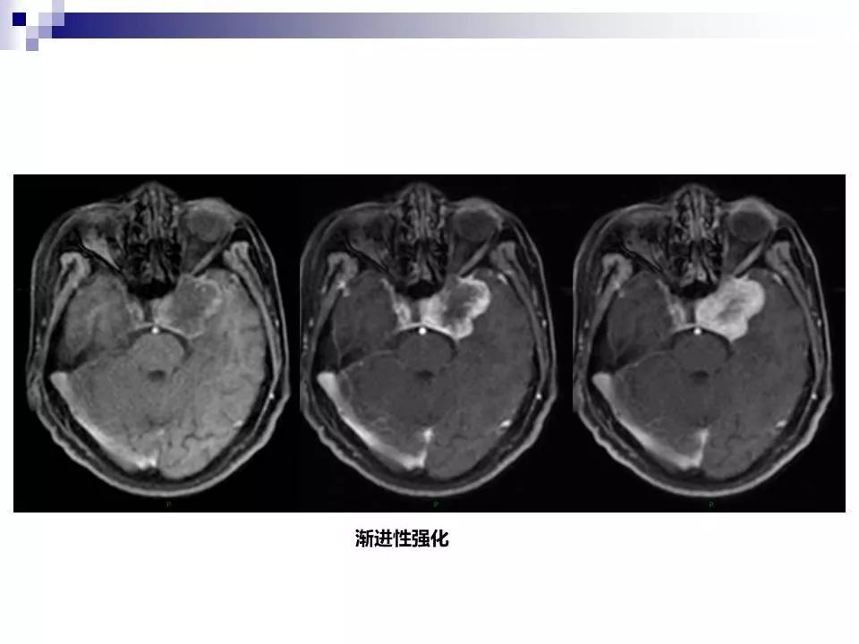 影像PPT - 各类脑血管畸形的病理基础、临床、影像学表现-61