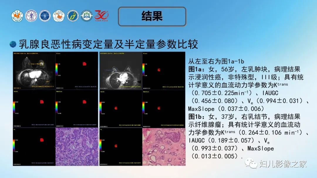 影像PPT - 【PPT】血流动力学参数在乳腺良恶性病中的诊断及鉴别诊断的价值-14