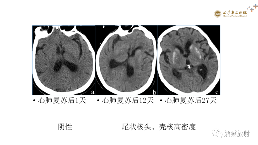 影像PPT - 【PPT】成人缺氧缺血性脑病影像学表现-11