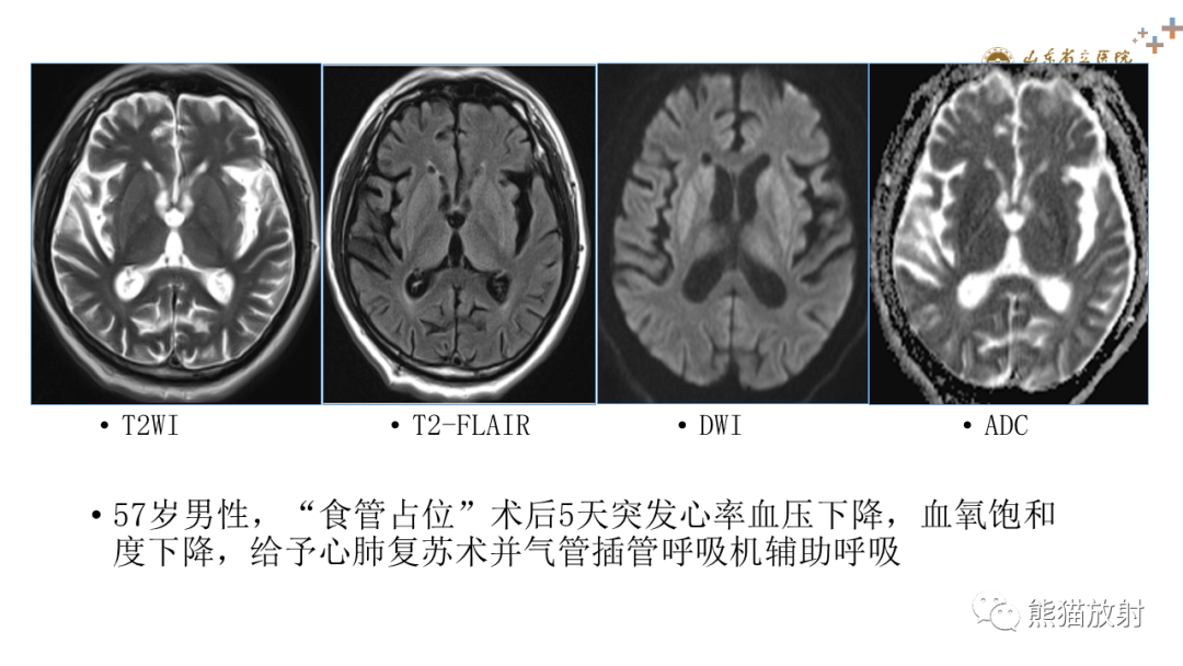 影像PPT - 【PPT】成人缺氧缺血性脑病影像学表现-17