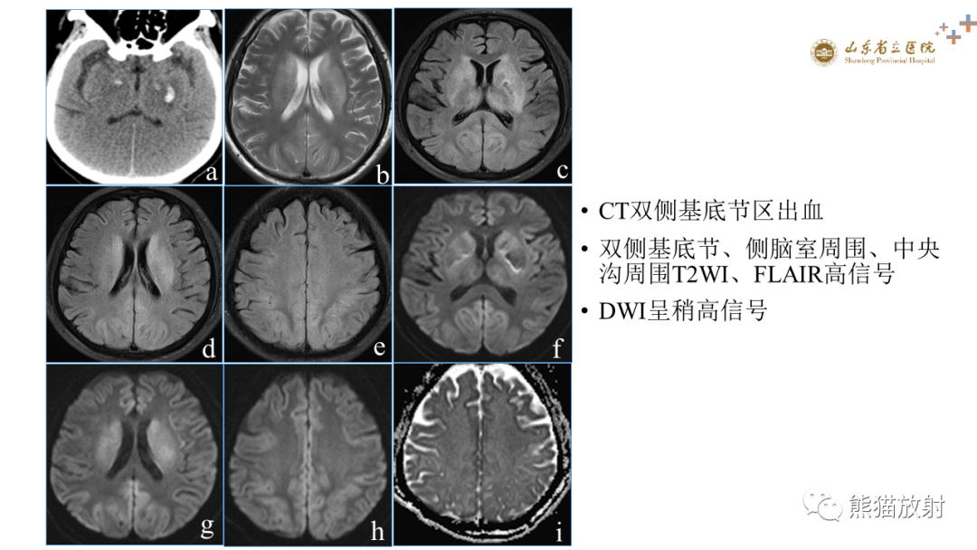 影像PPT - 【PPT】成人缺氧缺血性脑病影像学表现-20